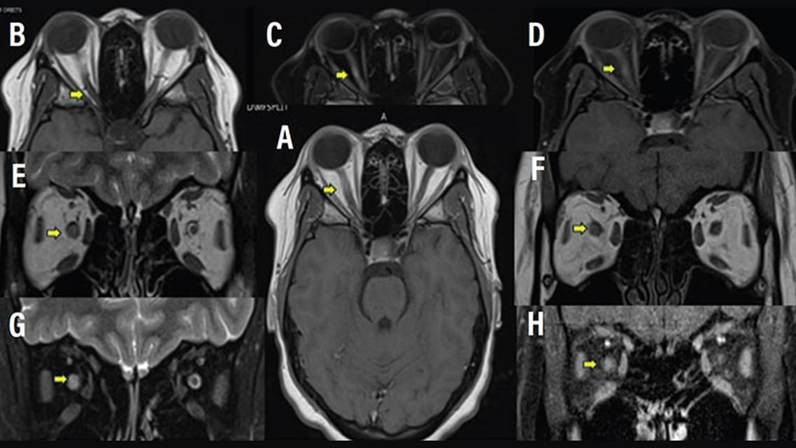 Neuro Ophthalmology Notions The Optic Nerve as Topographic Marker in the 2024 McDonald Diagnostic Criteria for Multiple Scle
