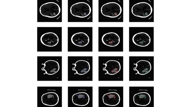Stroke Snapshot: Incorporating Artificial Intelligence in St