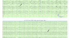 Figure 1 from the Epilepsy Essentials column article by Dr Smith and Dr Britton consisting of an EEG recording