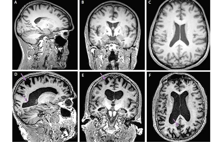 Neuroimaging and Alzheimers Disease