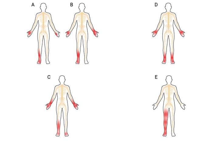 Diagnosis and Treatment of Vasculitic Neuropathy