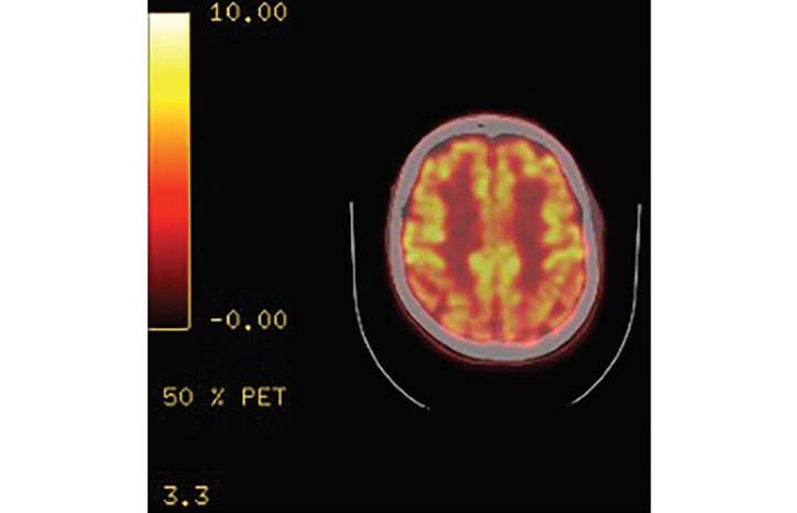 Symptoms of Lewy Body Dementia Induced by Herpes Zoster Encephalitis