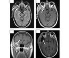 Sphenoid Wing Meningioma Presenting With a Temporal Fossa Mass