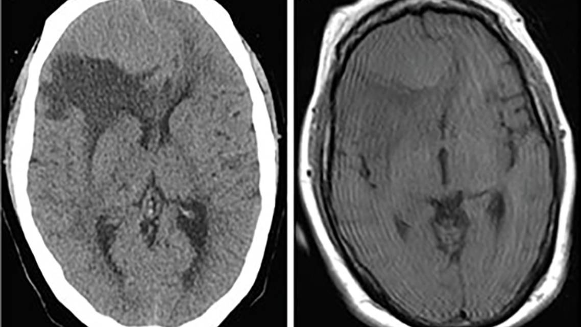 Special Report Neuro oncology