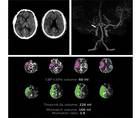 Stroke Snapshot Endovascular Thrombectomy for Stroke Treatment Outside the Established Criteria for Efficacy