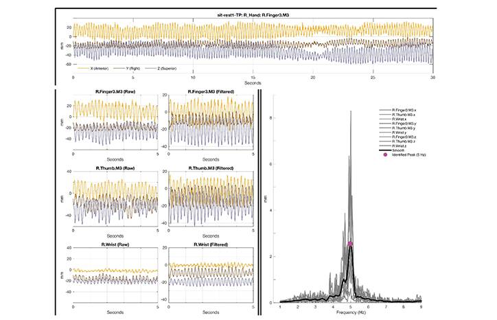 Movement Disorders Moment Use of 3D Motion Capture for Kinematic Analysis in Movement Disorders