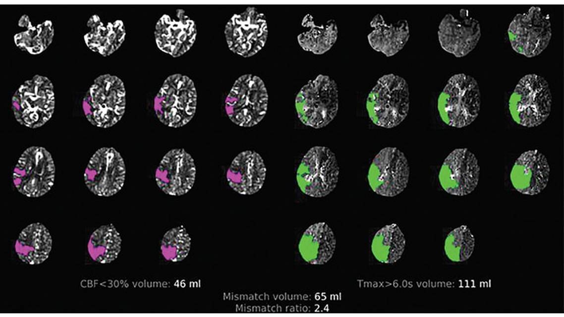 RAPID Automated CT Perfusion in Clinical Practice
