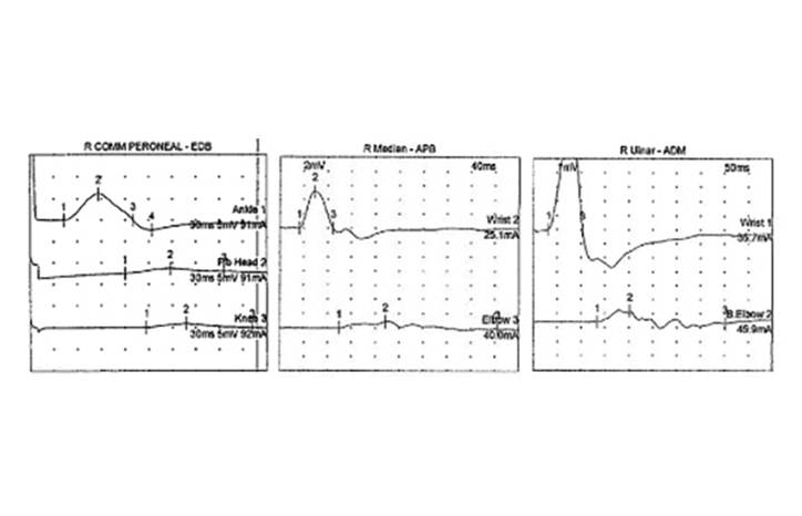 CIDP in an Adolescent After Pfizer BioNTech COVID 19 Vaccination