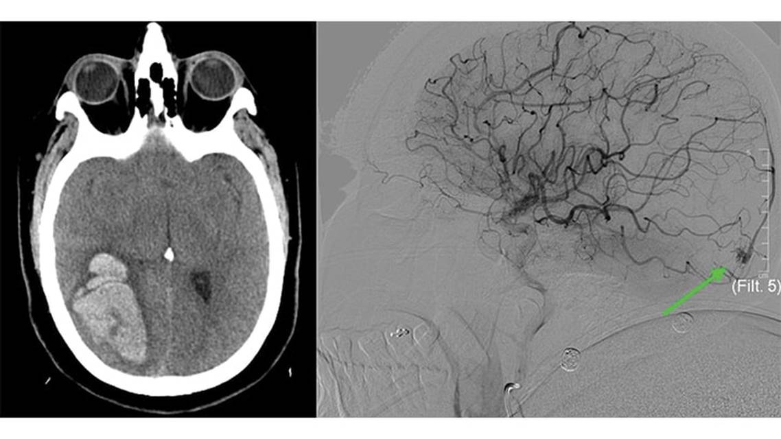 Spontaneous Intracranial Hemorrhage Secondary to Rare Pial Arteriovenous Fistula Rupture