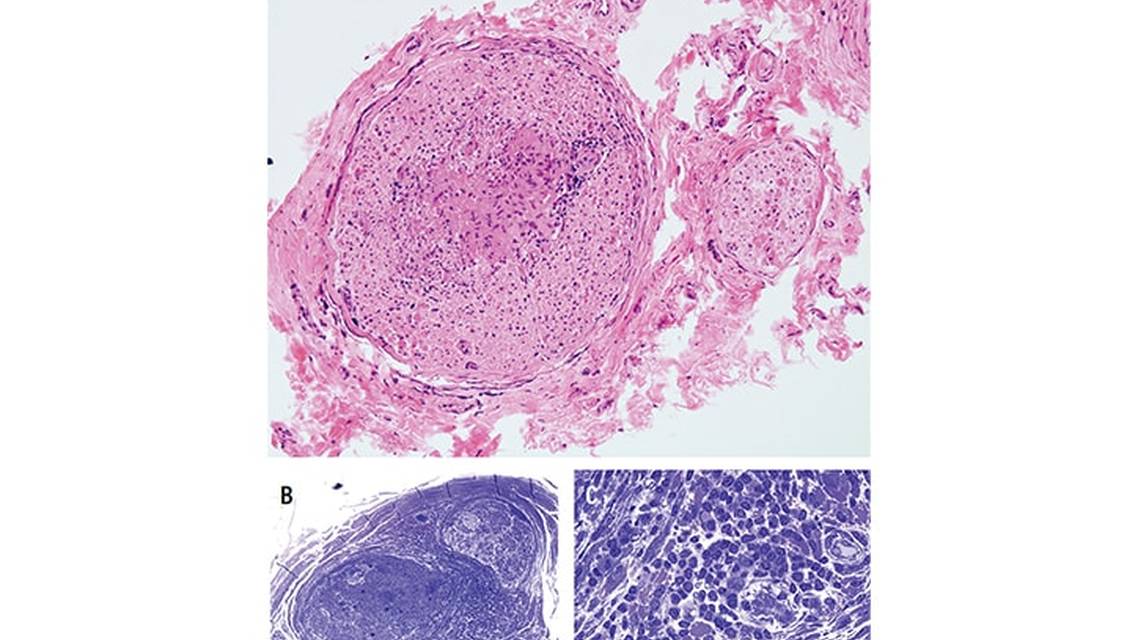 Neuromuscular Sarcoidosis Peripheral Nervous System Manifestations