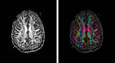 TBI Today Quantitative Diffusion Tensor Imaging for Assessment of Mild Traumatic Brain Injury