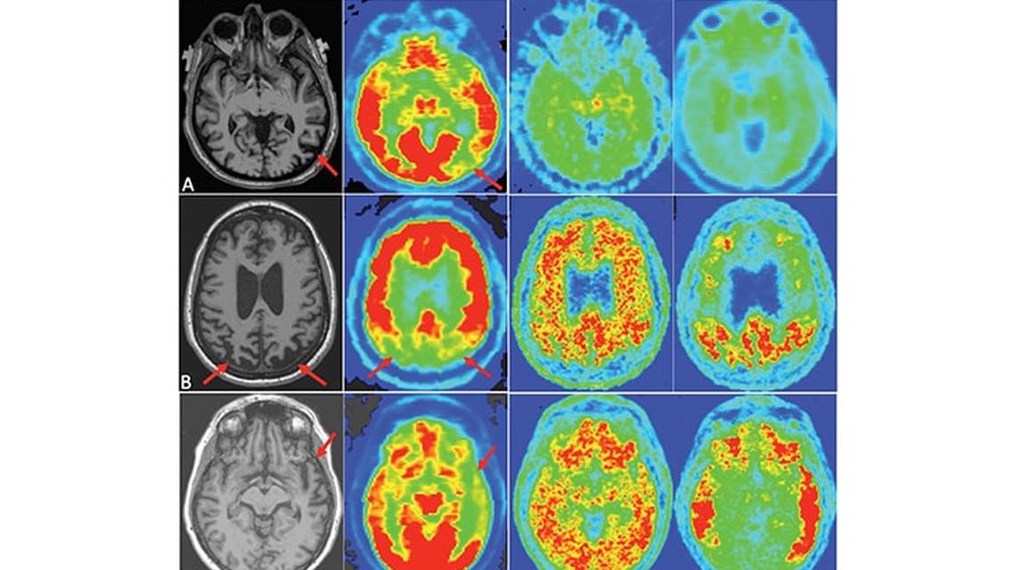 Dementia Innovations