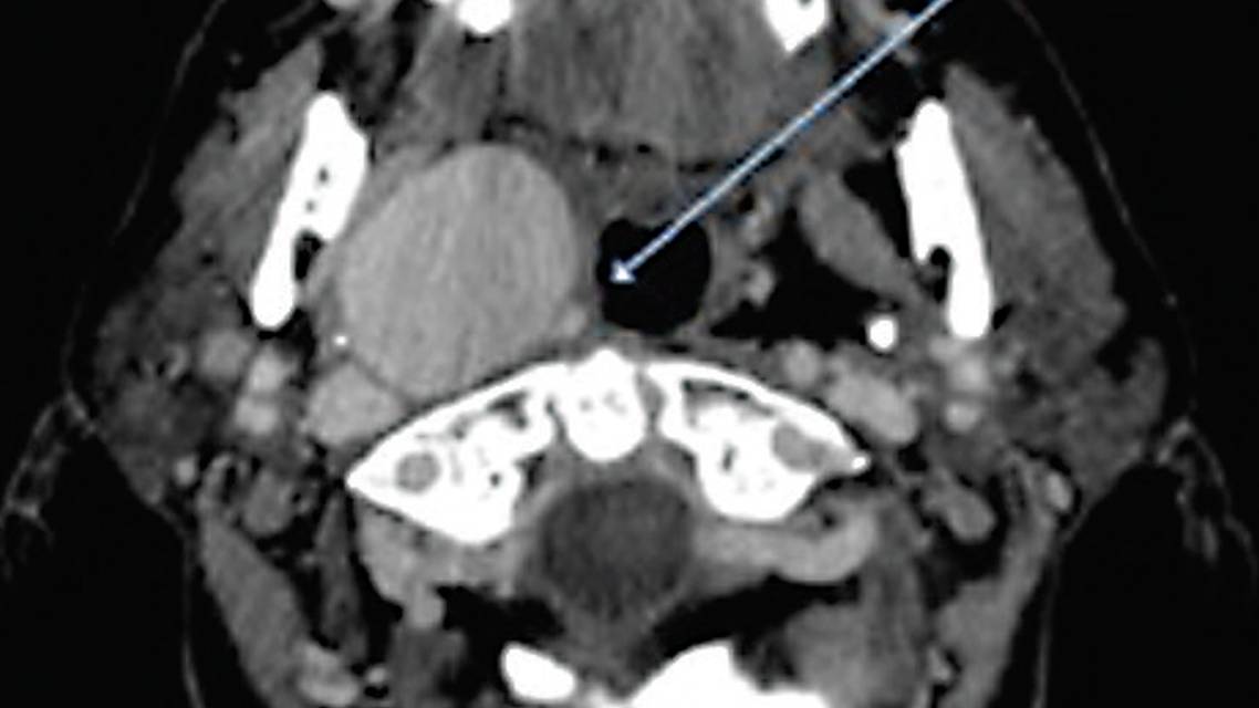 An Unusual Presentation of Syncope in a Patient With a Giant Cervical Carotid Aneurysm
