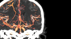 Hometown Highlights CGRP Related Treatments for Headache