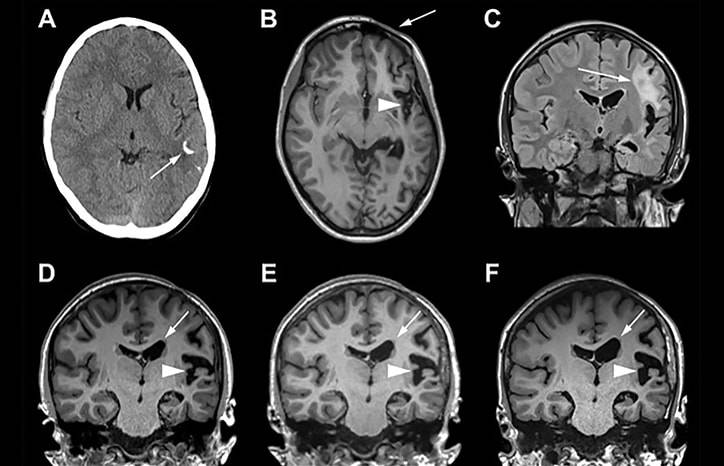 Parry Romberg Syndrome With Drug Resistant Epilepsy