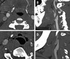 Stroke Snapshot Carotid Artery WebsEpidemiology and Pathophysiology
