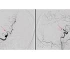 Stroke Snapshot Intracranial Vasculopathy in COVID 19
