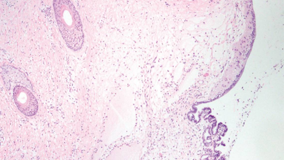 Case Report AntiNMDA Receptor Encephalitis