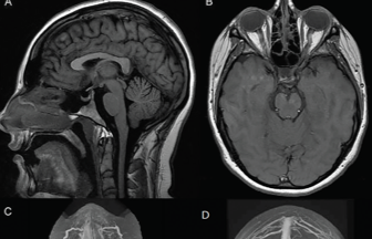 Idiopathic Intracranial Hypertension