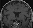 Stroke Snapshot Intracranial MRI Vessel Wall Imaging