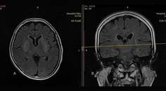 Fatal Rabies Failure of Postexposure Prophylaxis