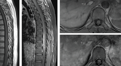 Neuroschistosomiasis