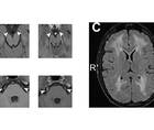 Case Reports Mitochondrial Neurogastrointestinal Encephalopathy