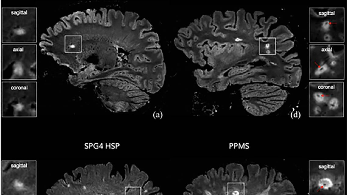The Central Vein Sign