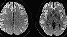Hyperammonemic Crisis