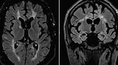 Case Report Hemiparkinsonism in a Patient With Multiple Sclerosis