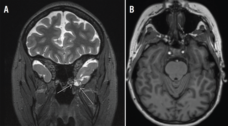 functional neurologic symptom disorder -