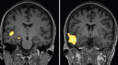 A Case of AntiGAD65 Autoimmune Musicogenic Epilepsy