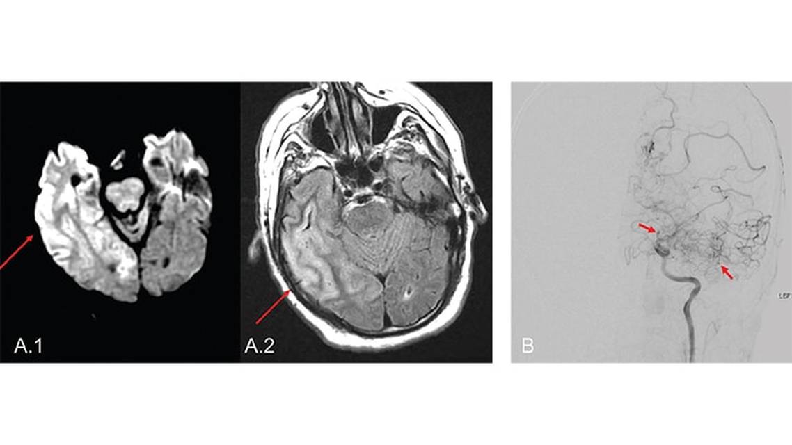 Neurologic Complications of Globally Prevalent Infectious Disorders A Focus on Syphilis Cysticercosis and Tuberculosis