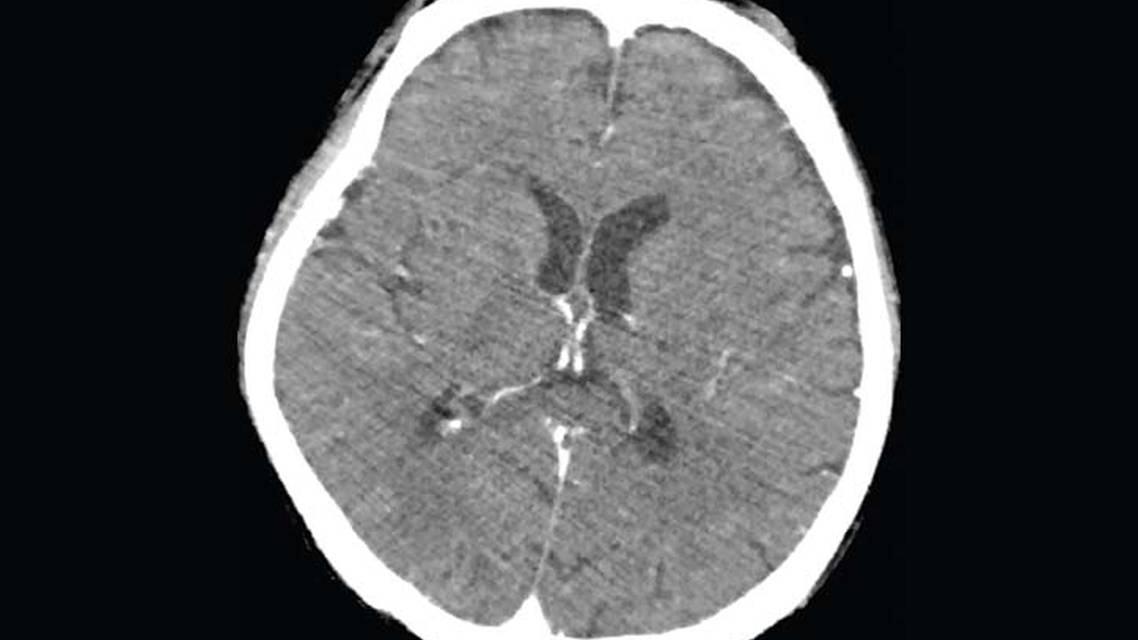Eosinophilic Meningitis After Eating Freshwater Snails