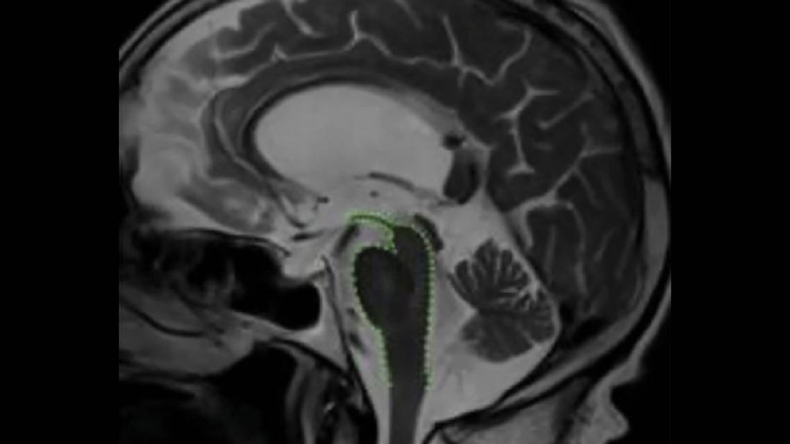 Atypical Parkinsonian Syndromes
