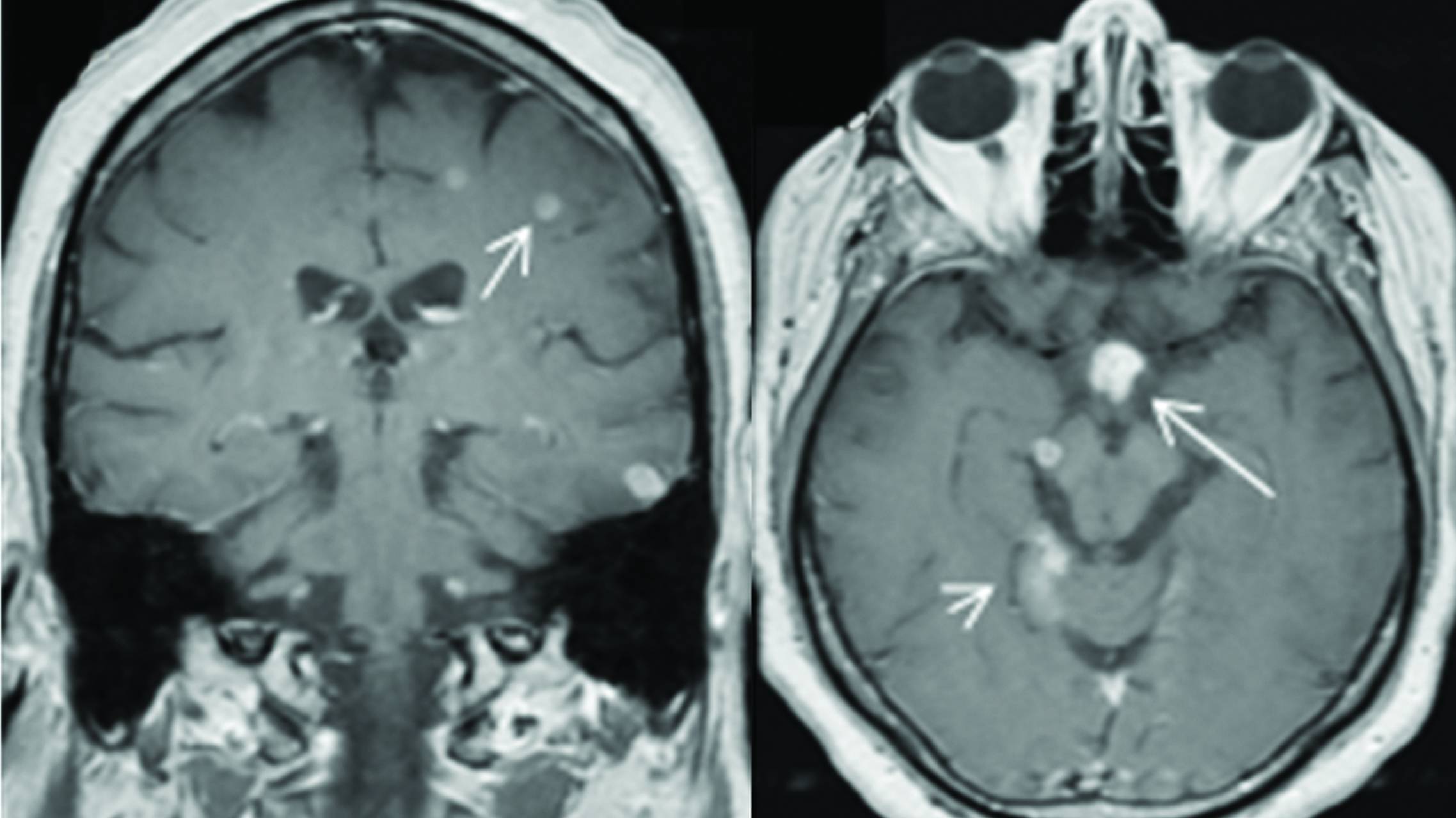 Intracranial Infections: Bacterial, Viral, Fungal, Parasitic