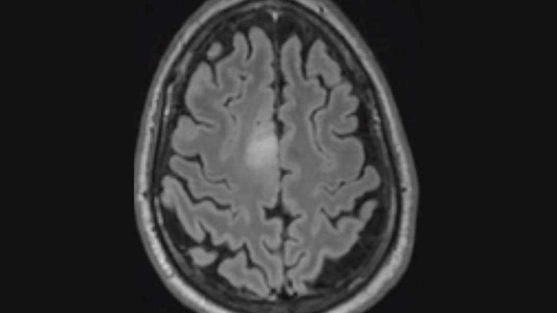 Challenge Case Report New Onset Seizures