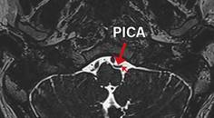 Persistent Idiopathic Isolated Hypoglossal Nerve Palsy