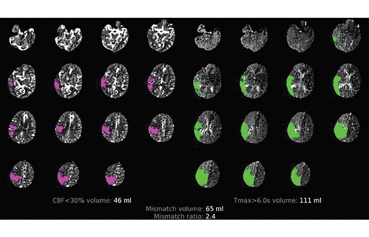 RAPID Automated CT Perfusion in Clinical Practice