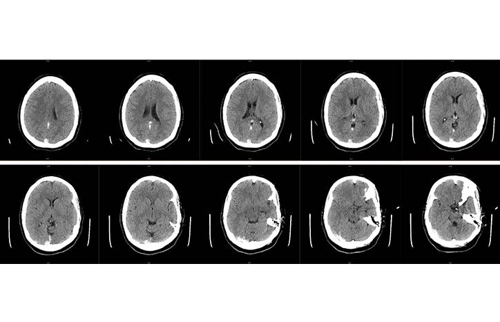 Management of Vein of Galen Thrombosis With Mechanical Thrombectomy