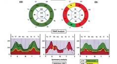 Neuromyelitis Optica Spectrum Disorder in Castleman Disease
