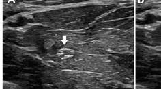 Neuromuscular Notes Neuromuscular Ultrasound in Polyneuropathy