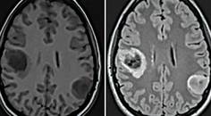 Challenge Case Report New Onset Seizures and Brain Lesions in First Trimester