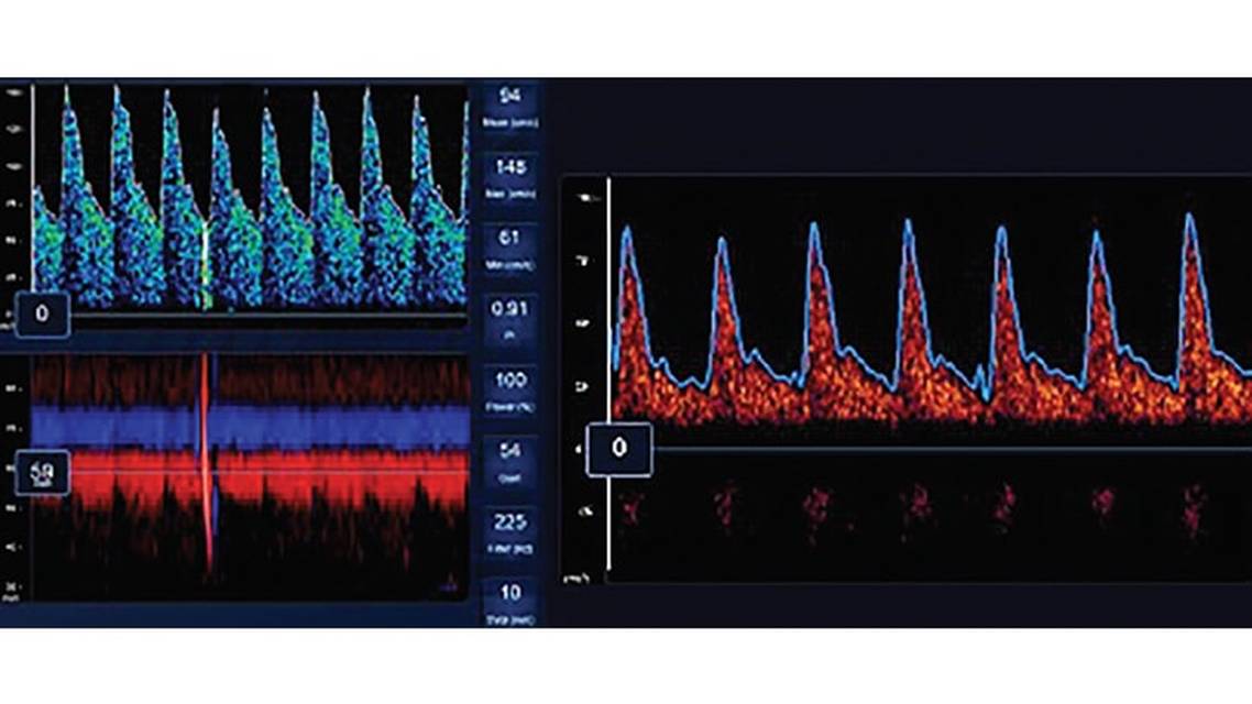 Neurologic Assessment and Neuromonitoring in the COVID 19 Pandemic