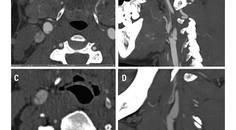 Stroke Snapshot Carotid Artery WebsEpidemiology and Pathophysiology