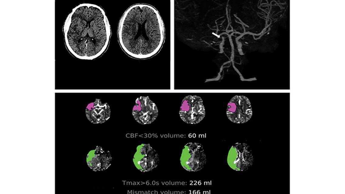 Stroke Snapshot Endovascular Thrombectomy for Stroke Treatment Outside the Established Criteria for Efficacy