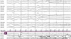 Epilepsy Essentials VideoEEG Analysis