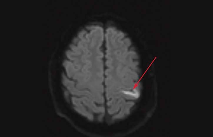 Stroke Snapshot Ulcerative Colitis and Stroke