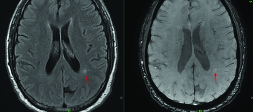 Radiologic Biomarkers in Multiple Sclerosis