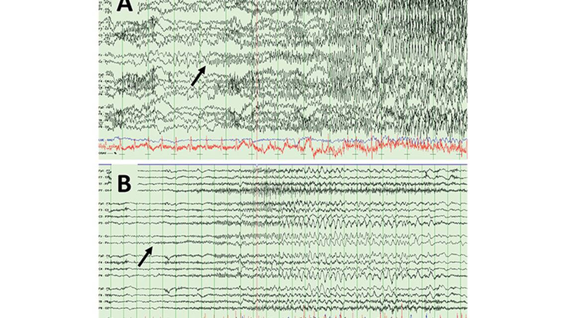 Spotlight on SleepDispelling the Sleep Spell Hypermotor Seizures Parasomnias and Leveraging Sleep Medicine in Pediatr